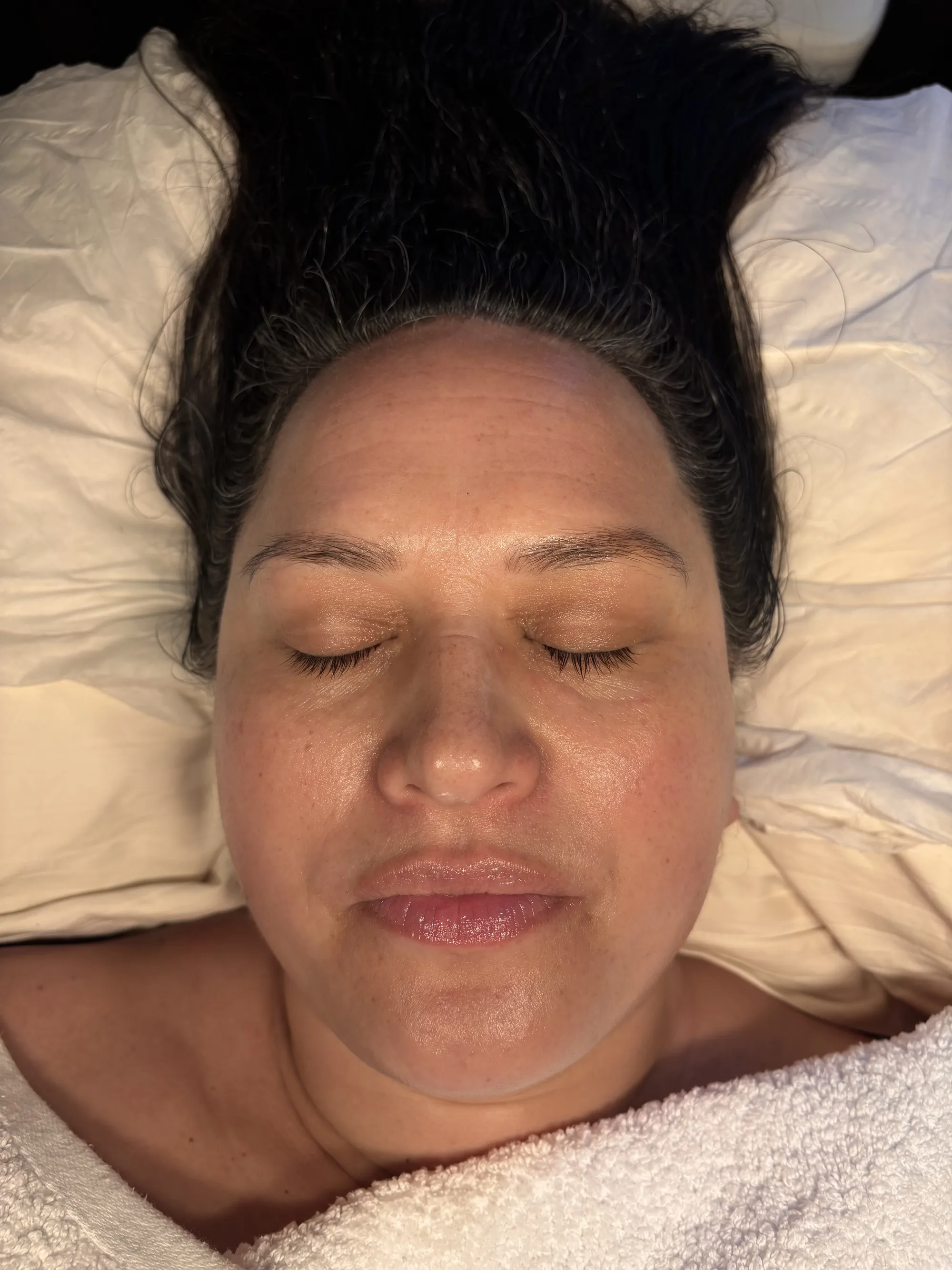Client resting peacefully after her skin treatment at Novauria Aesthetics