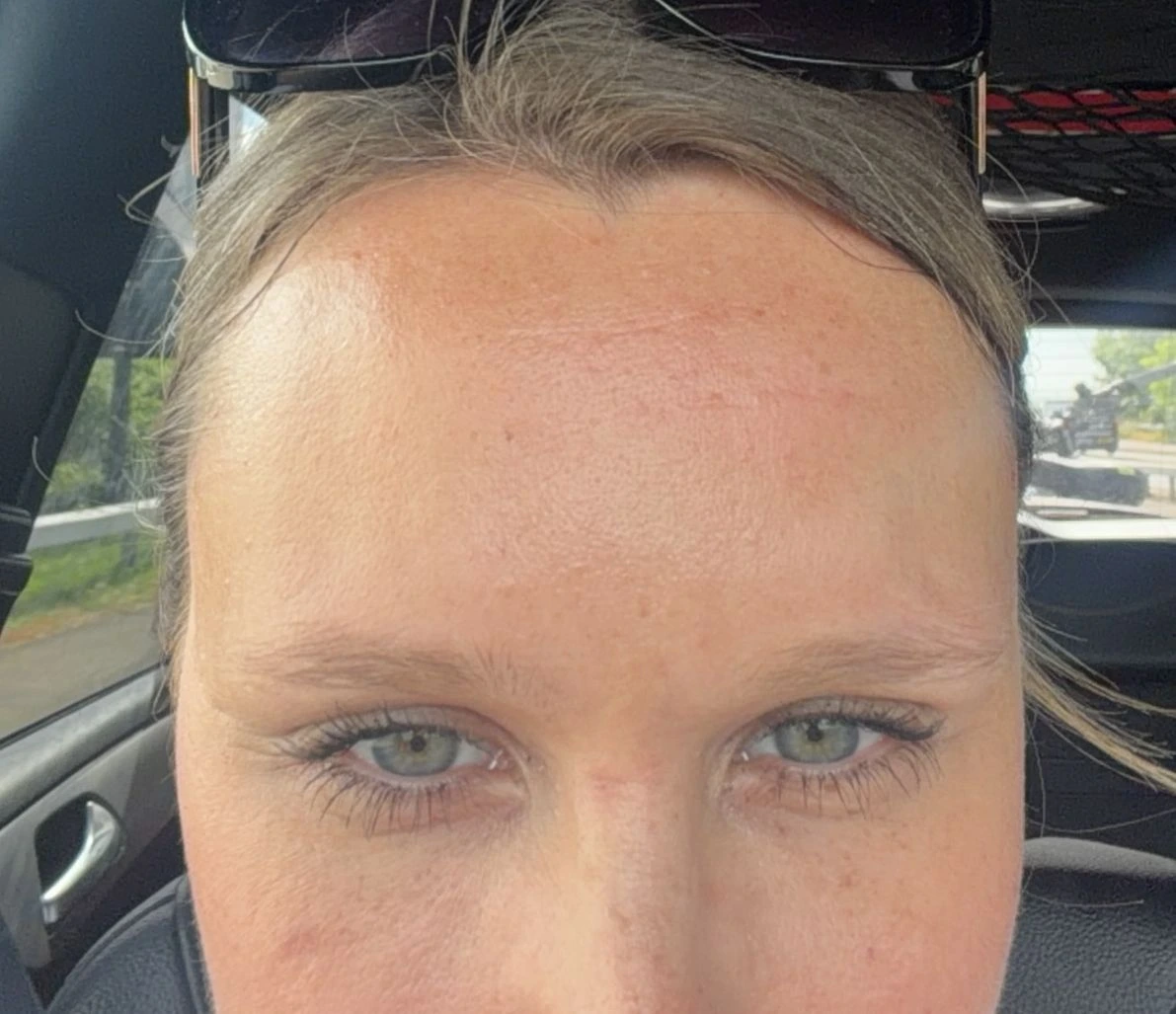 Anti-Wrinkle Injections